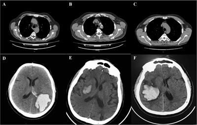 COVID-19-Related Intracerebral Hemorrhage
